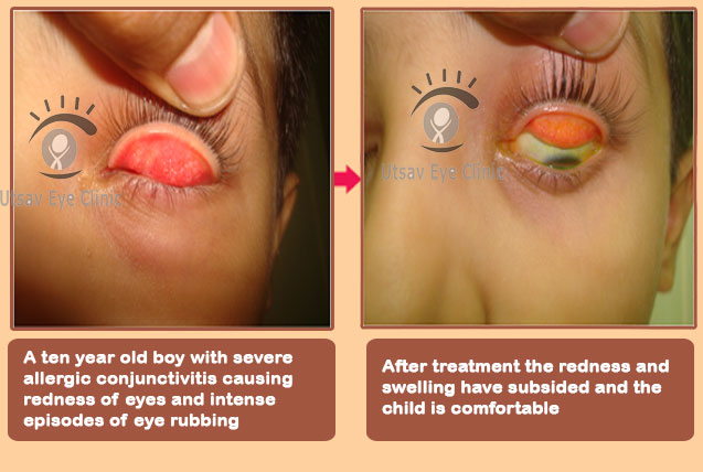 Allergic conjunctivitis in children