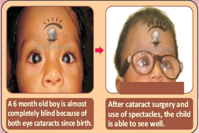 Cataract surgery in children