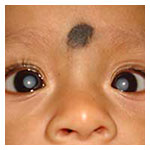 Cataract in children