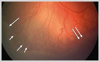 retinopathy of prematurity in navi mumbai