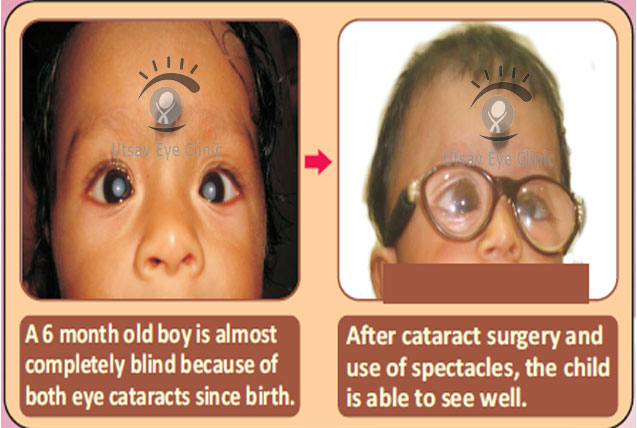 cataract treatment in children