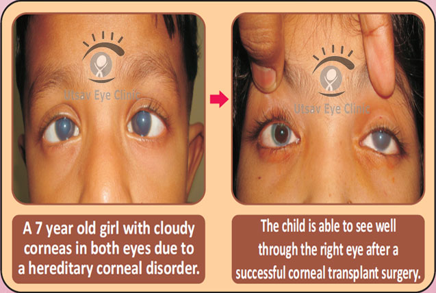correction of corneal opacity in children
