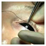treatment of drooping of eyelids navi mumbai india